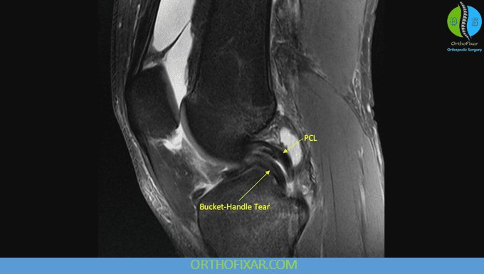CT vs MRI: Differences, Indications and Image Interpretation 7 sagittal proton‑density sequence - Knee Meniscus tear