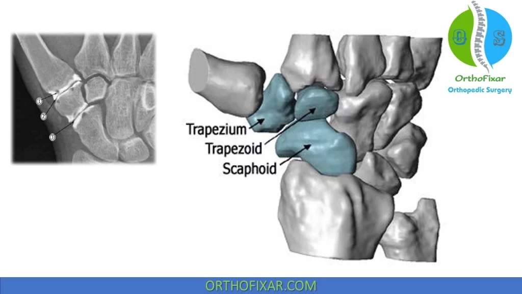 scapho-trapezio-trapezoid joint