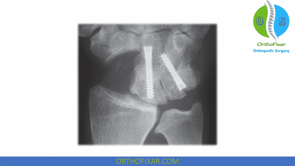scaphoid excision and 4 corner arthrodesis