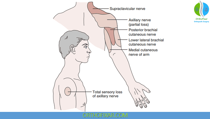 Axillary Nerve Injury 5 sensory loss of axillary nerve