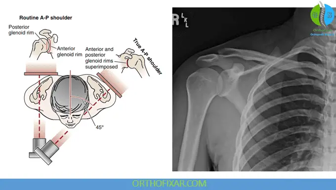 Shoulder X-ray Views 1 shoulder anteroposterior radiographic view