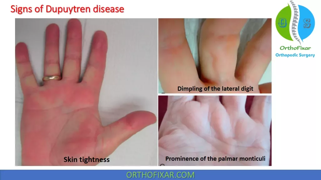 signs of Dupuytren disease 