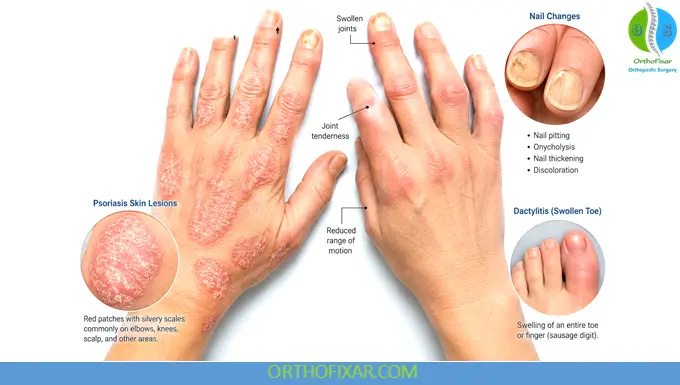 Psoriatic Arthritis: Symptoms, Causes, Diagnosis & Treatment 6 signs of psoriatic arthritis