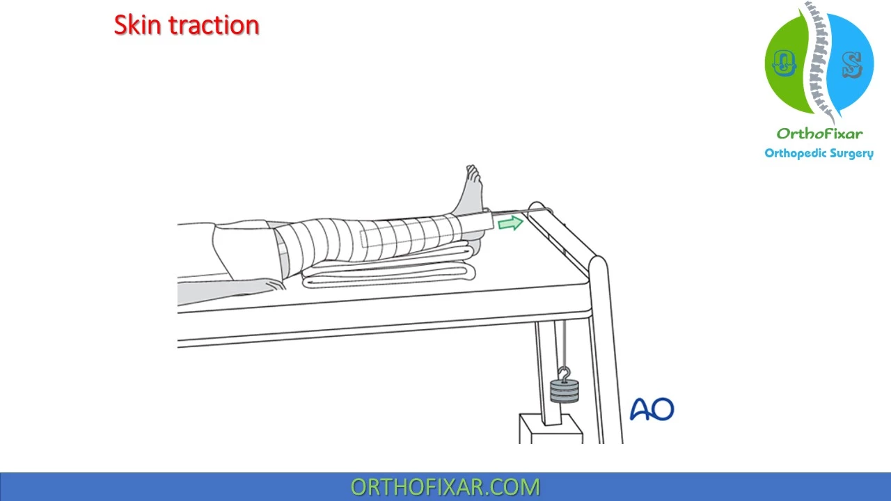 Skeletal Traction Types & Indications