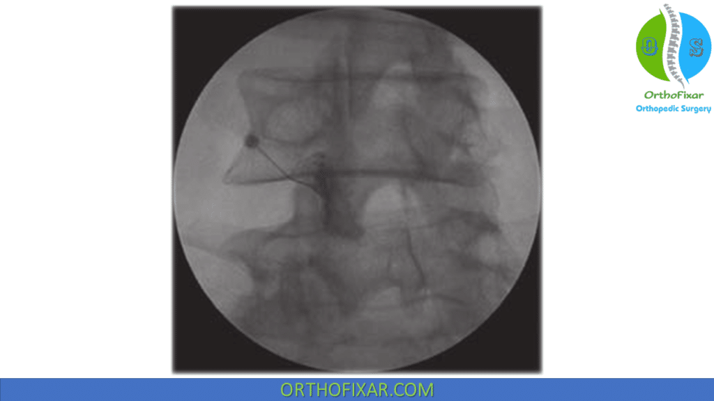 spinal facet injection with fluoroscopy