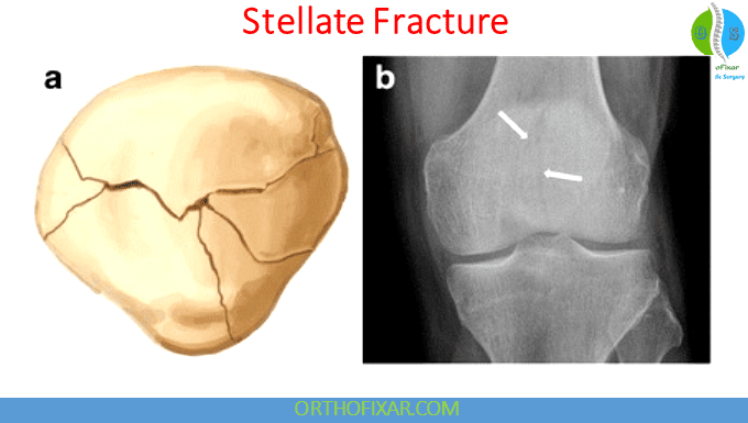 Patellar Fractures | Broken Kneecap 10 stellate fracture