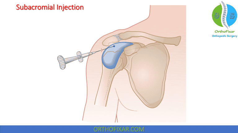 Subacromial Inj Shoulder Injection Techniques: Posterior, Anterior & Lateral Approaches
