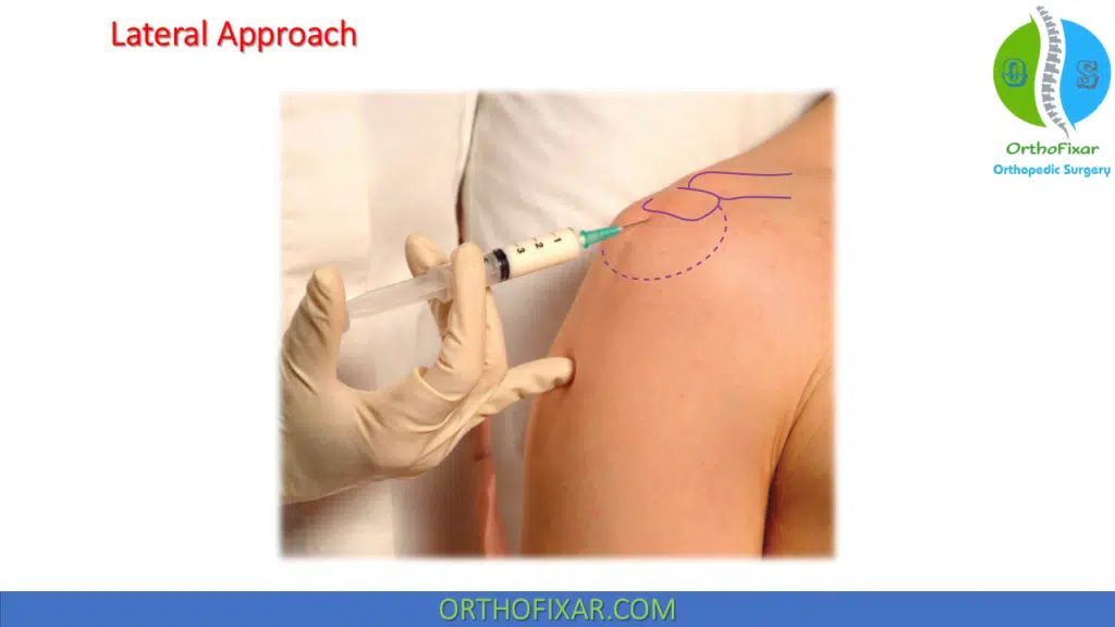 Shoulder Injection Techniques 6 subacromial injection lateral approach