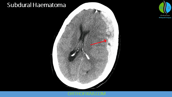CT vs MRI: Differences, Indications and Image Interpretation 6 subdural haematoma seen on CT