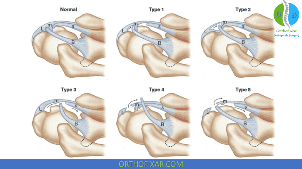 Long Head Of Biceps Tendon OrthoFixar 2024