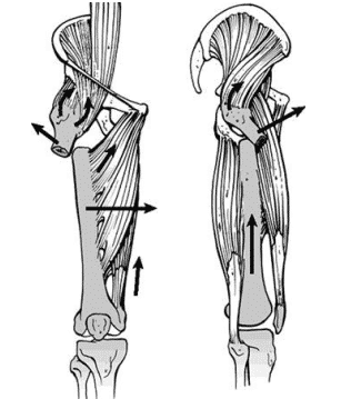Subtrochanteric femur fracture's most common deformity after antegrade nailing