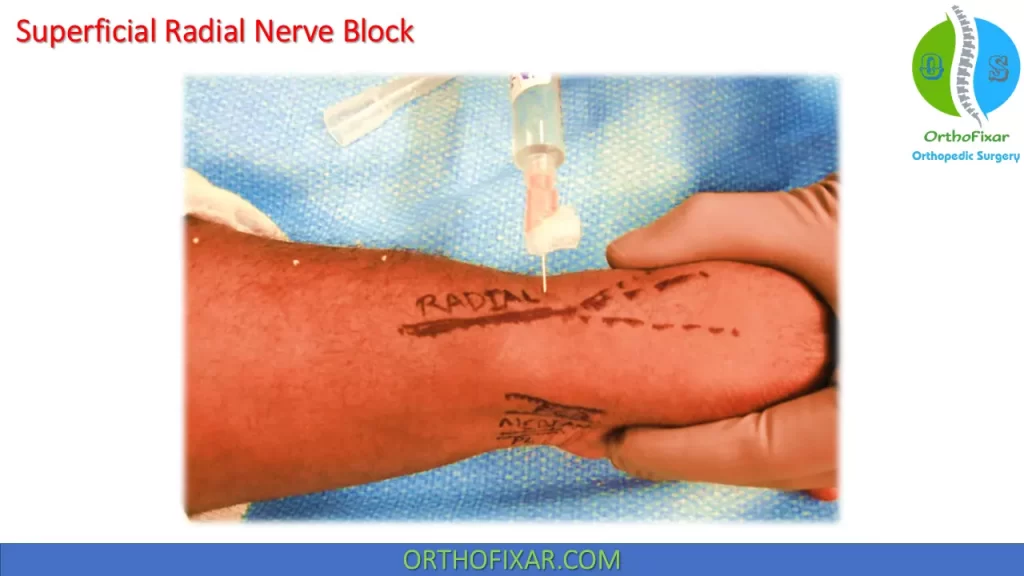 superficial branch of the radial nerve block