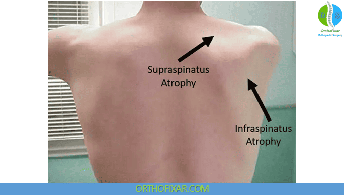 Suprascapular Nerve Injury 2 supraspinatus and infraspinatus atrophy