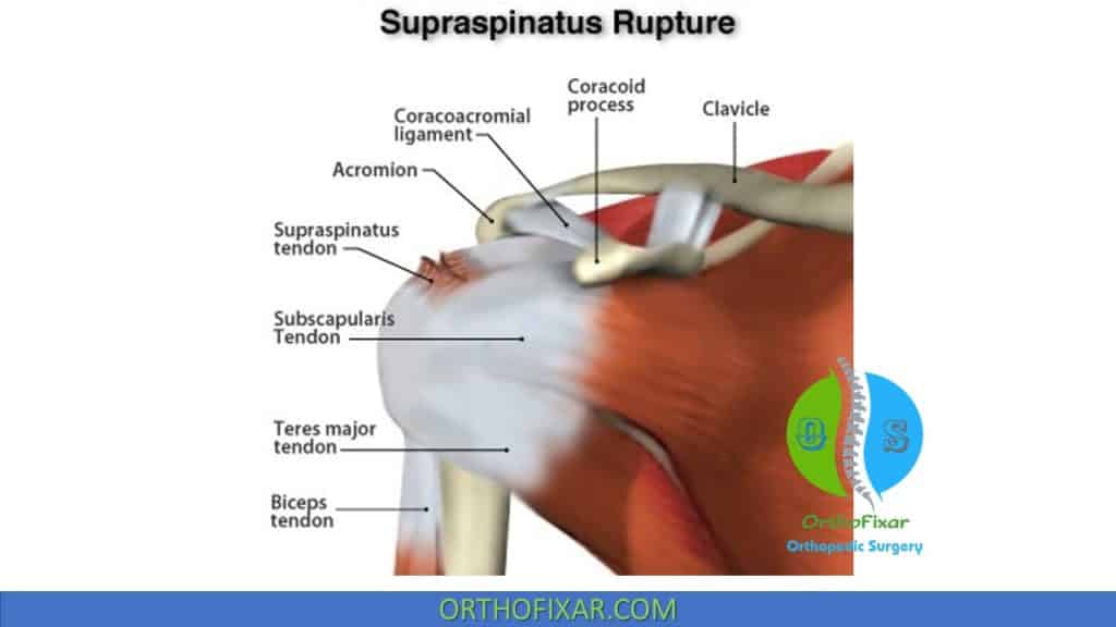 supraspinatus tendon tear