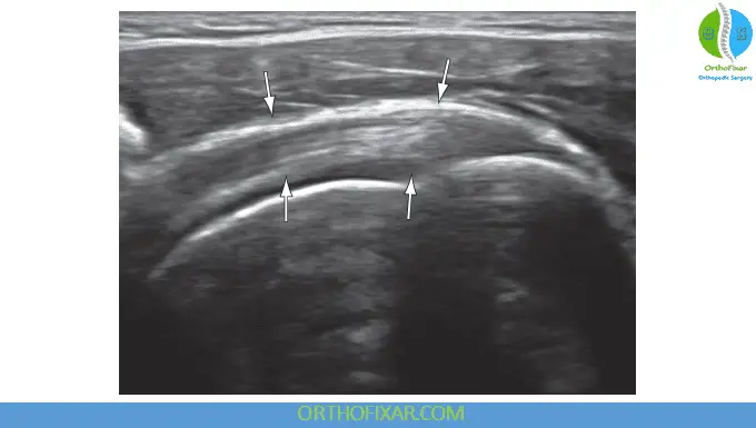 supraspinatus tendon ultrasound