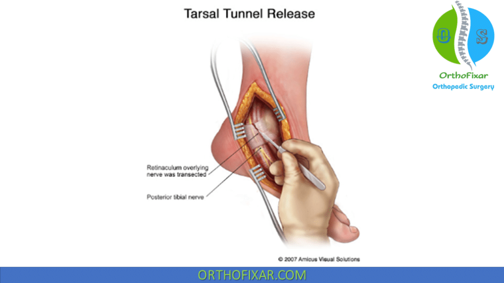tarsal tunnel release surgery