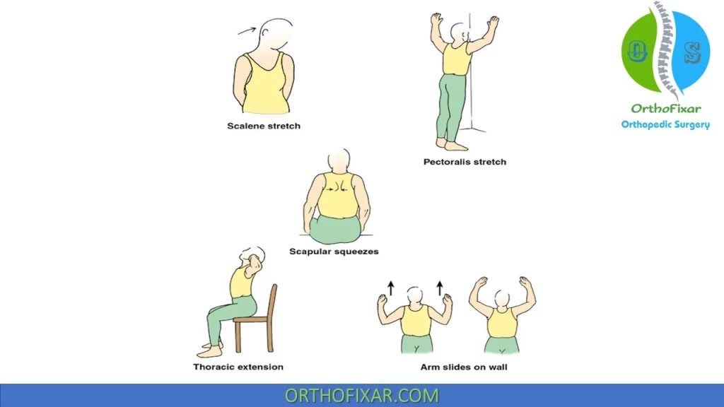 Thoracic Outlet Syndrome Physical Therapy