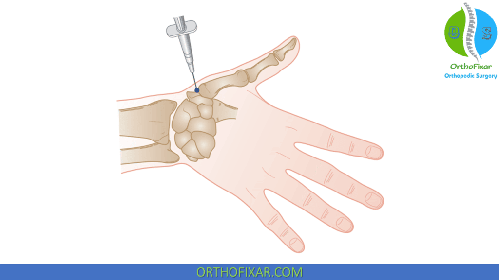 CMC Joint Injection OrthoFixar 2025