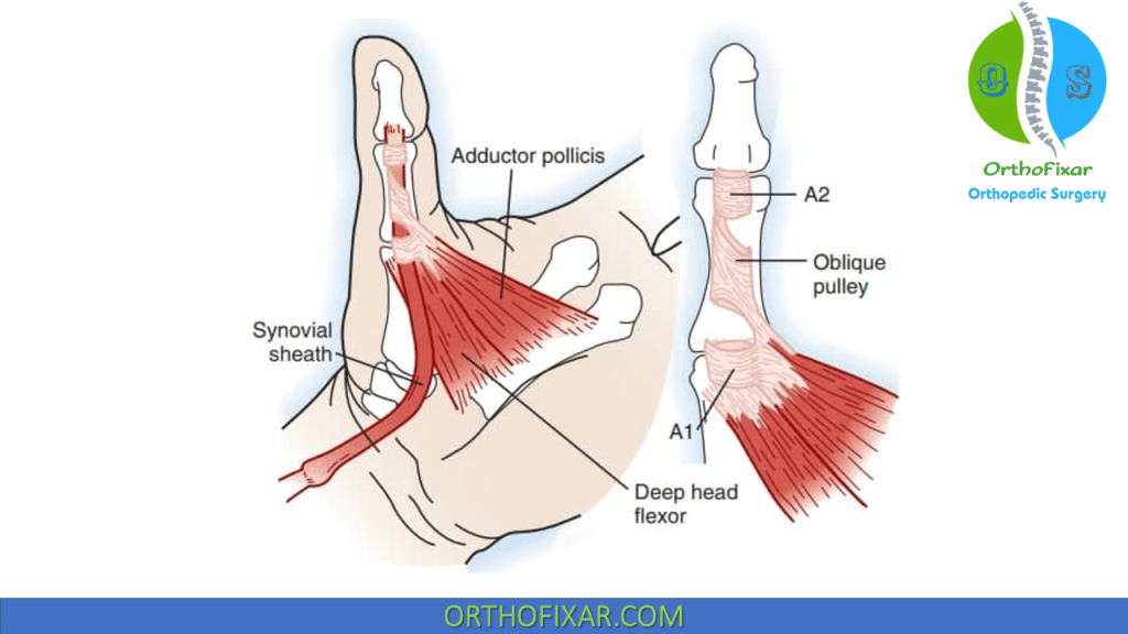 Trigger Finger or Trigger Thumb: Otherwise Known as Stenosing Tenosynovitis  - Premier Physical Therapy