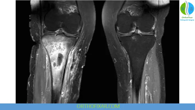 Osteomyelitis: Causes, Symptoms, Diagnosis & Treatment 5 tibia Osteomyelitis