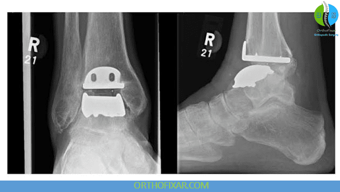 total ankle replacement xray
