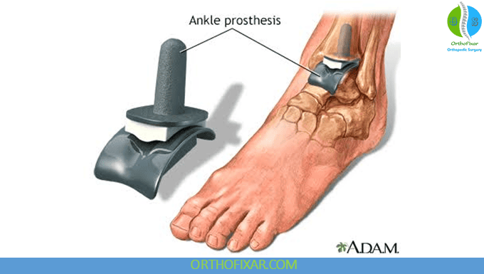 total ankle replacement