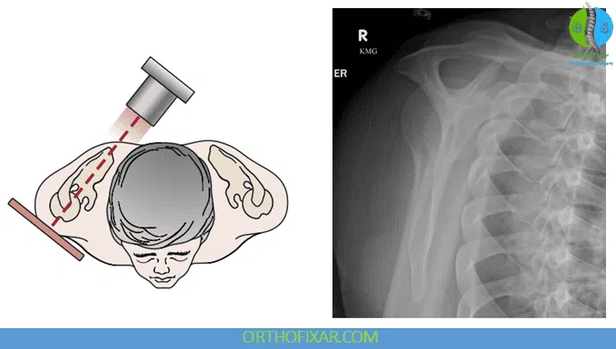 Shoulder X-ray Views