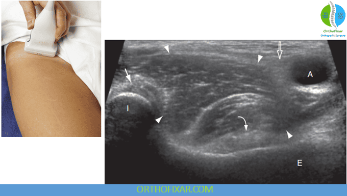 transverse Anterior Hip Ultrasound