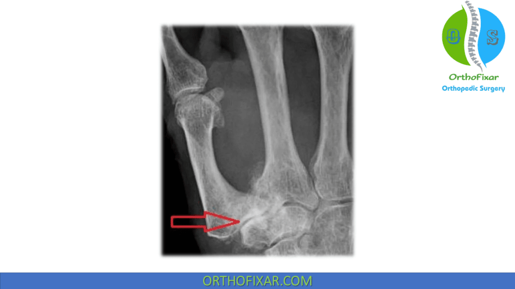 trapeziometacarpal joint arthritis