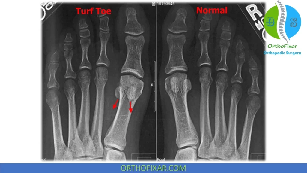 turf toe imaging