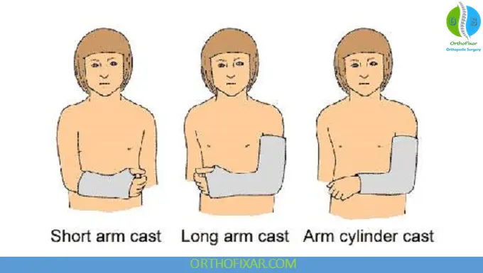 Fracture Casting: Principles, Techniques & Complications 8 upper limb casting