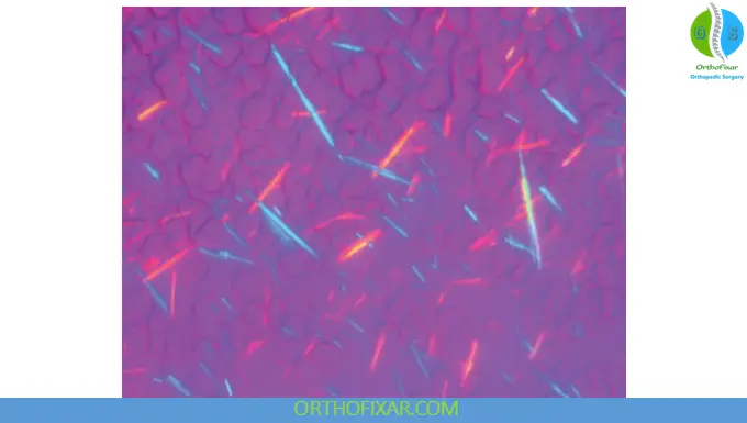 uric acid crystals