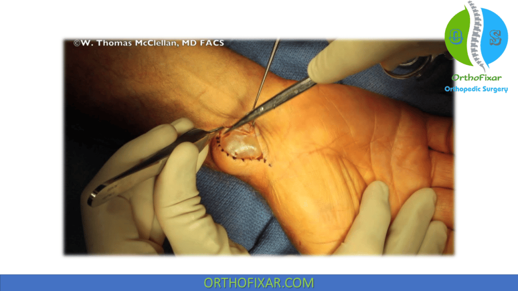 volar ganglion cyst wrist treatment