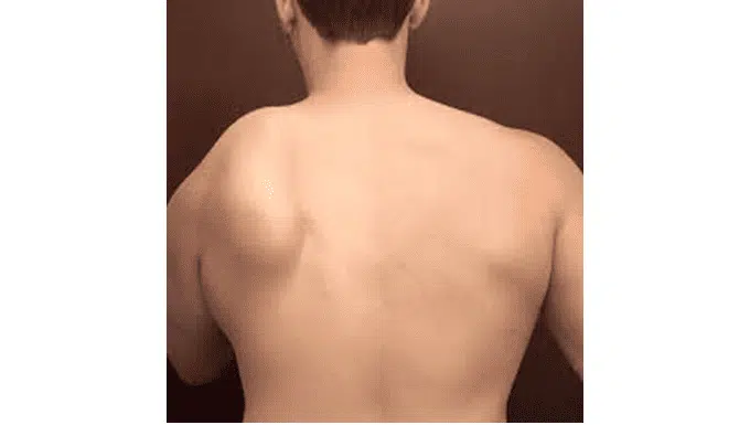 winging scapula