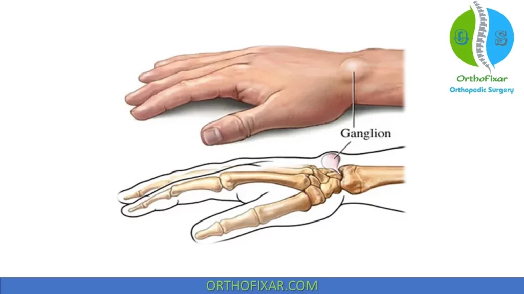 wrist ganglion